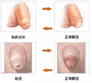 寶雞包皮手術(shù)后龜頭是否會變得敏感