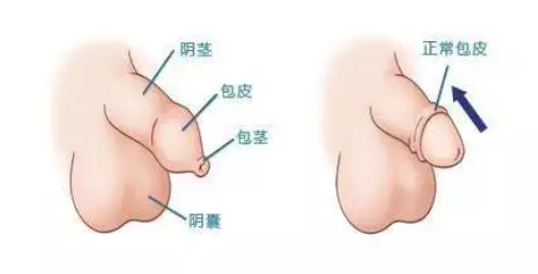 寶雞元寶山區(qū)啥樣的算是包皮過長(zhǎng)