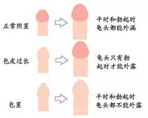 寶雞寧城縣【專業(yè)男科】包皮手術(shù)后多久可以痊愈呢